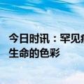 今日时讯：罕见病需早筛早诊早治 关注罕见病群体点亮罕见生命的色彩