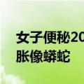 女子便秘20多年差点撑爆肚子：结肠异常膨胀像蟒蛇