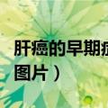 肝癌的早期症状是什么样子（肝癌的早期症状图片）